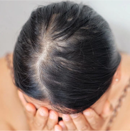 Alopecia - The Challenge