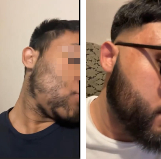 sabr-remedies-alopecia-before-and-after