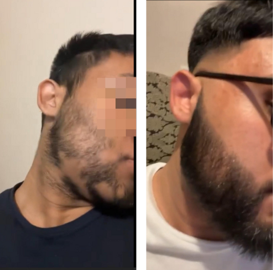 sabr-remedies-alopecia-before-and-after